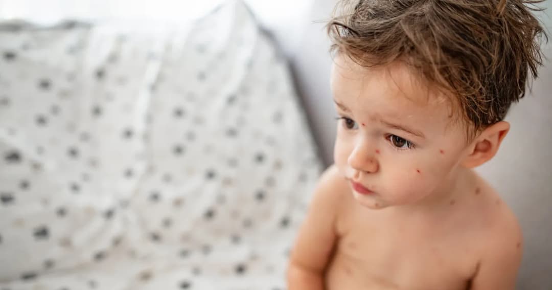 Czy dziecko zaszczepione na ospę może zachorować? Sprawdź, co musisz wiedzieć